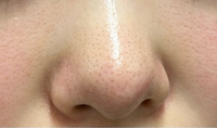 これは何毛穴でしょうか？
顔脱毛５回行ってます 