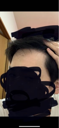前からだとこんな感じの生え際で上からだとmっぽくなるんですけど上から見てmだとAGAですか生え際は右左同じ感じです。 