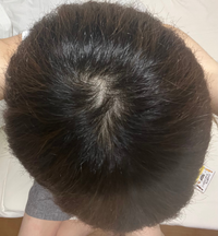 後頭部が禿げてきて悩んでます。若いのでなんとか進行を止めたいです。ま... - Yahoo!知恵袋