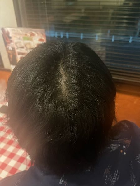 22歳です。禿げてきてますか、、？それと将来禿げやすい髪質とかです