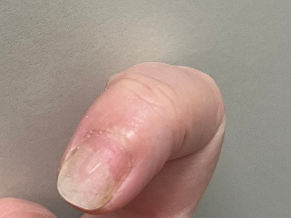 爪剥離症のネイリストです。 お写真ケアなどしていない状態で汚くすいません…。 昔スカルプ練習などで1本だけ剥離症になってしまい(10年前)もうスカルプはしてはいないのですが、ジェルネイルを施術すると2日で3分の2剥離してしまいます。 ジェルネイルの硬化で爪が伸縮し剥離しているのだと思います。 仕事場がネイルサロンなのでネイルをしてはいたいのですがどうしても剥離してしまいます。 過去、ジェルを約1年お休みしました。その時は剥離はせず、お休みした後ジェルネイルをすると剥離しました。 1、剥離は何度も繰り返すのでしょうか。 2、いい解決方法など、剥離させない施術方法などありますでしょうか。 3，剥離を何度も繰り返す原因で平爪になっているのが原因で硬化が浮いてしまうのでしょうか。 (病院の塗り薬では治りませんでした…。ジェルを薄く塗るなどしましたが駄目でした。) 同じ経験の方など、知恵がある方教えて頂きたいです。長々と読んで頂きありがとうございました。
