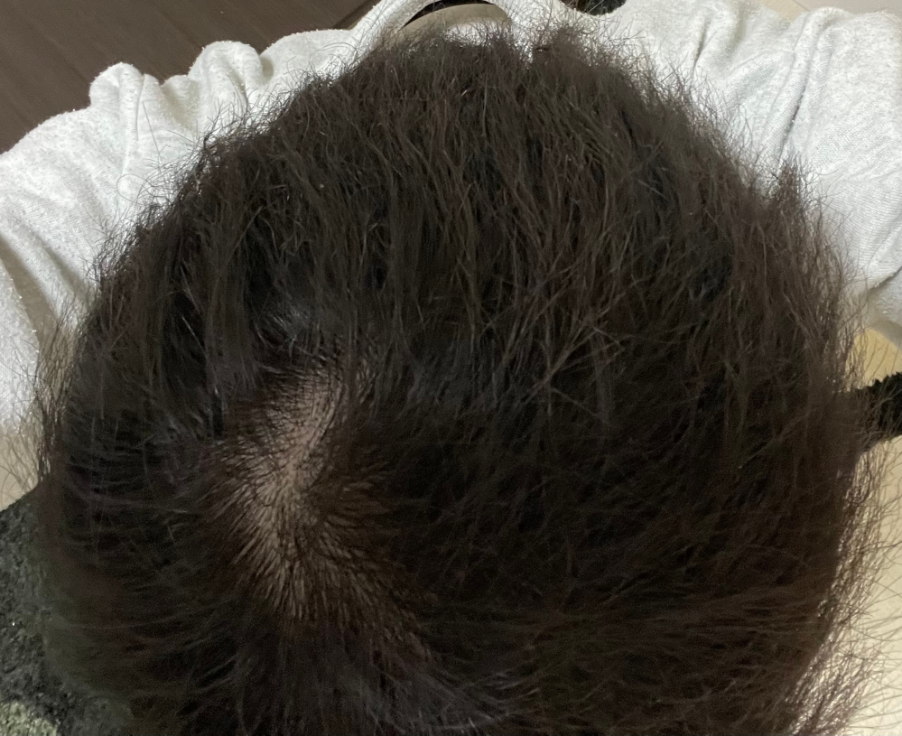29歳男です。これはつむじはげですか？