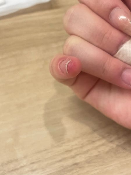 至急(写真付き) セルフネイルで固めるマニキュアみたいなやつが少しとび出て最初はかゆいなーくらいだったんですけどとうとう紫色なってました( ꒪⌓꒪) 小指だけです。アレルギーですか？