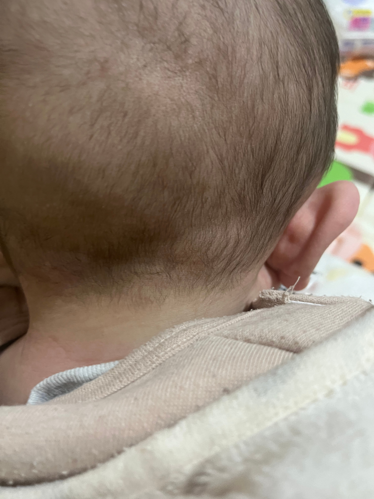 生後五ヶ月の赤ちゃん、後頭部（右耳から5センチ程度）のリンパ節のまわりが3センチほど楕円形にぽっこり膨らんでます。（画像中央あたり） 左側はそんなことないです。 ぶつけたりもしておりません。気付いたのは最近ですが、以前からこんなような頭の形だと思っていたような記憶があります。 小児科ではリンパ節のまわりに液体が溜まってるのでは？とか、脂肪ですよ、とか、小児科によって回答がまちまちだったので、今度エコーが取れる病院にいってくるつもりです。 リンパ節のこりこりのまわりの皮膚が、ふっくら盛り上がってふくらんでて、感触はぷにぷにしてます。 悪性リンパ腫とかではないかと不安で仕方ないです。 もし何かご存じの方、医療従事者の方、うちもあったよーなどという方いらっしゃったら教えてください(T . T)