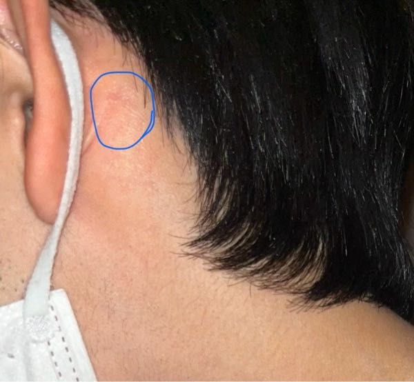 しこりと写真 - 悪性リンパ腫のしこりは、こんな風になるんですか?? - Yahoo!知恵袋