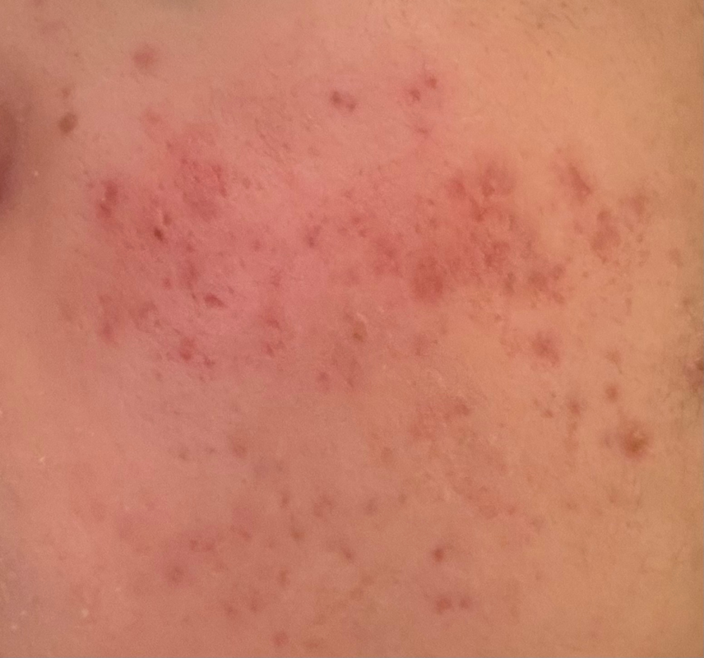 ニッキーズのスキンクリアを使ってるのですが、あまり効果を実感しま