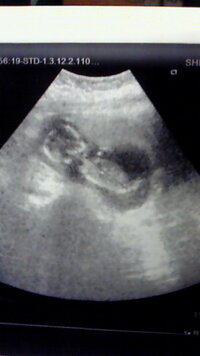 ただいま１５週で妊娠４ヶ月の妊婦です 今日お腹にジェルを塗って超音波 Yahoo 知恵袋