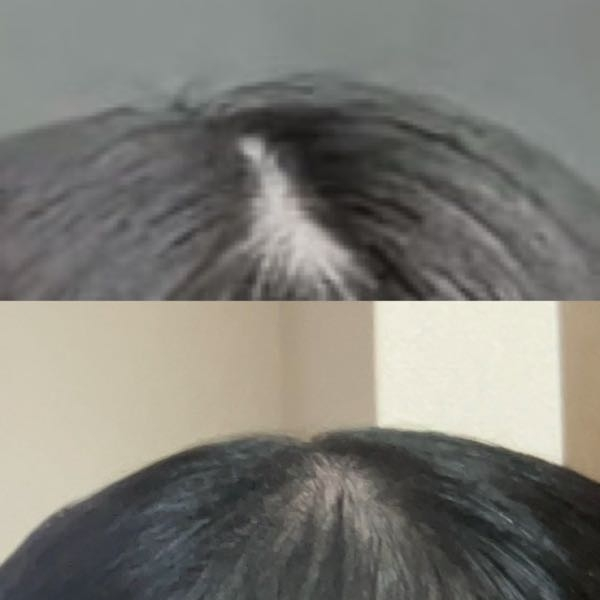 【至急】どちらの方が禿げてる様に見えますか？上の方が見えてる面積広いと思うのですが。