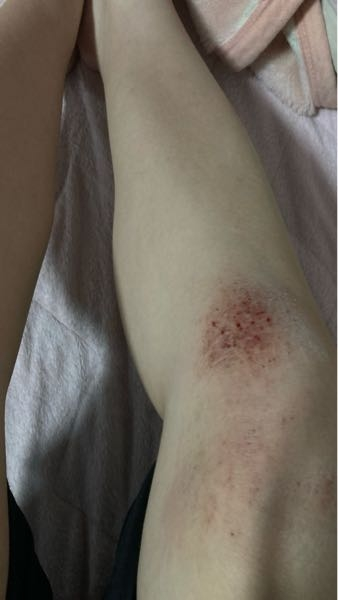 バレー部に入っています。 肘と膝がサポーターのせいなのか痒すぎてやばいです。何を塗っても悪化する一方です。どうすればいいですか。