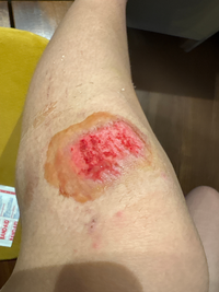 4日前に転んで怪我した擦り傷です。化膿していますか？キズパワーパッド... - Yahoo!知恵袋