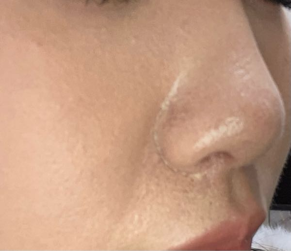 小鼻の横が写真のような崩れ方をしてしまうのですが、何かいい対処法等はありませんか？ モロモロ？した感じでひび割れの様にハゲてます。 鼻の下、顎の下も同じように崩れます。 下地はラロッシュポゼ、KATEのファンデとダーマシンコンシーラー、パウダーはデコルテです。 どなたかお願いします(´；ω；｀)