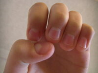 深爪を治したい 高2女子です 小さい頃から爪噛み癖があり 画像の通り汚 Yahoo 知恵袋