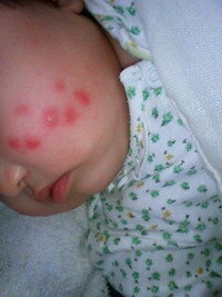 生後4ヵ月の赤ちゃんの顔に出来た赤いブツブツについて1カ月程前から頬が乾燥して Yahoo 知恵袋