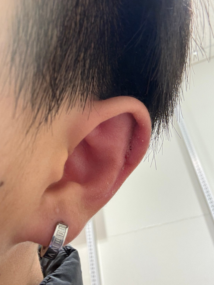 （至急） こんにちは 自分は3週間前に軟骨ピアスを開けたのですが 朝起きると耳が異様に痛く、鏡で見てみると軟骨ピアスが埋まっていました どうしたらいいですか？押しても痛くて動かせません 回答よろしくお願いします