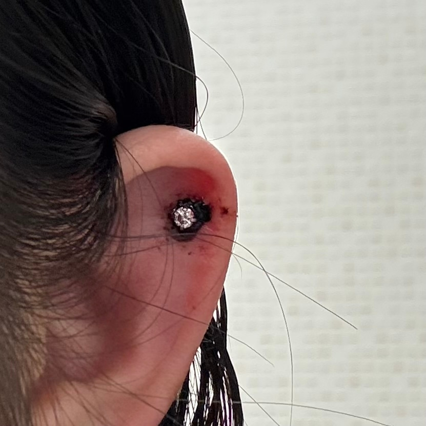 昨日軟骨をあけたのですが出血してカサブタができています(>_<)どう処置をすれば良いか教えてください。ホットソークをするべきなのか悩んでいます。