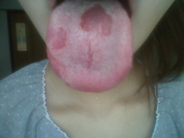 舌が変なんです。写真のようにまだらです。赤い部分が痛い時もあります 