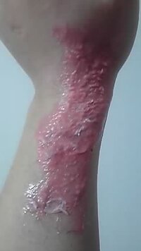 ワックス脱毛をしようとした際 剥がしたところ べっとり肌側にワッ Yahoo 知恵袋