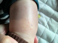 ７カ月赤ちゃん 足首にブツブツが おとつい位に発見したのですが７カ月 Yahoo 知恵袋