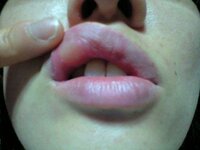 口唇の内側が腫れてきました ちょっと前から 上唇の内側が腫れて Yahoo 知恵袋