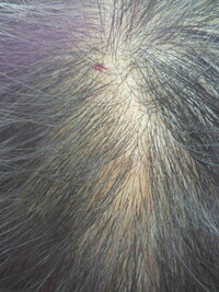 頭皮に赤い斑点が二個くらいあるのに一週間前に気がつきました ほっておくとまずい Yahoo 知恵袋