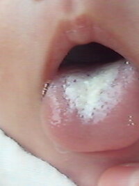赤ちゃんの舌について 二ヶ月の完ミの赤ちゃんがいます 舌が写真のよう Yahoo 知恵袋