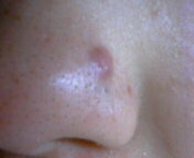 赤い もの 鼻 でき 【医師監修】鼻に大人ニキビができる原因と治し方
