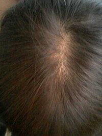 中学三年の女です 薄毛で悩んでます これってやっぱり薄毛ですよね 頭頂部 Yahoo 知恵袋
