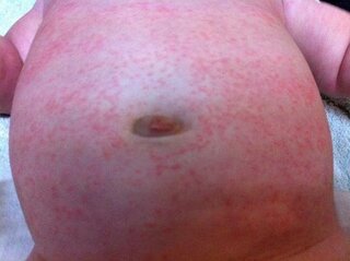 生後3ヶ月お腹のブツブツについて 生後3ヶ月の赤ちゃんのお腹に Yahoo 知恵袋 生後3ヶ月お腹のブツブツについて 生後3ヶ月の赤ちゃんのお腹に Yahoo 知恵袋