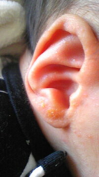生後2ヶ月の赤ちゃんの耳がこの状態なのですがこれは耳垢ですか Yahoo 知恵袋