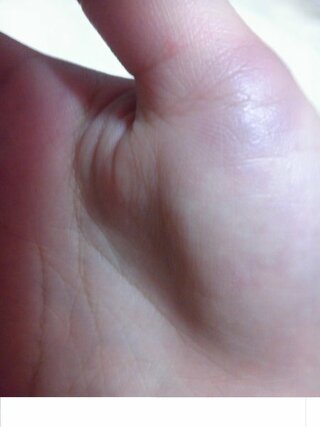赤あざ 突然手のひら 親指の付け根 にあざができました １ヶ月ほど前にも中指の Yahoo 知恵袋