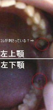 上の歯が下の歯茎に刺さっている 最近 左の下顎第三大臼歯 親知らず が Yahoo 知恵袋