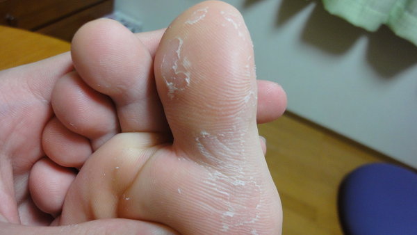 足 の 親指 の 皮 が むける