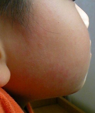 子供 湿疹 かゆみ なし 顔の湿疹の原因と病気を子供と大人別に かゆみなしや突然の時も