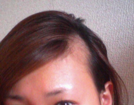 前髪 円形脱毛症 女性 前髪の円形脱毛症におすすめのウィッグ