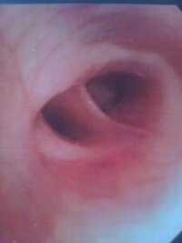 肺過誤腫による肺切除についてctで右中葉に腫瘍が確認され 気管支内視 Yahoo 知恵袋