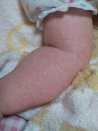 生後4ヶ月の赤ちゃんの腕 足に赤い斑点 発疹 のようなものができまし Yahoo 知恵袋