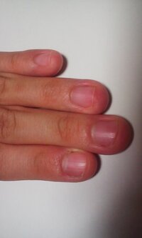 小さい頃から爪を噛む癖があり今までずっと続けてきました深爪を通り越し Yahoo 知恵袋