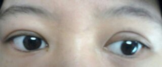 助けて 整形失敗 昨日 眼科で二重整形を受けました 写真の 右の方の目は内 Yahoo 知恵袋