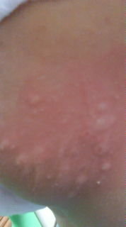 子どもの湿疹について2歳の子どもの足と腕に湿疹が出ています 火曜日に Yahoo 知恵袋