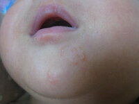 乳児湿疹 ヘルペス 生後日の赤ちゃんの目の間 目の下に昨日から Yahoo 知恵袋