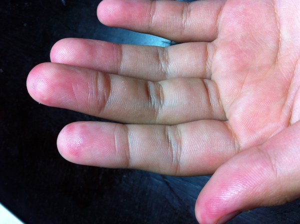 子供の手の指先の赤み、痛みについて画像に有る様に、子供の指先だけが - Yahoo!知恵袋