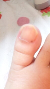 爪の中にほくろ 画像注意 気付いたら右足の親指付け根にほくろ Yahoo 知恵袋