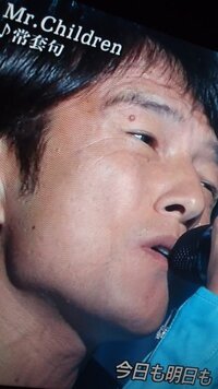 ミスターチルドレンのボーカルの右目の上のイボは必要ですか イボコロリ Yahoo 知恵袋