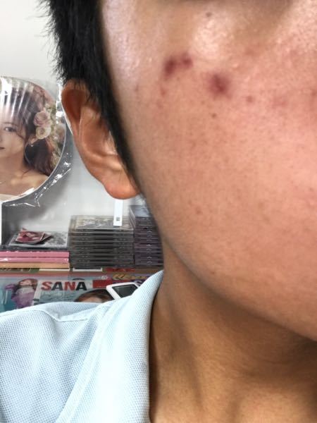 色素沈着に効く薬で市販で売ってるのありますか 色を黒くする薬の事 Yahoo 知恵袋