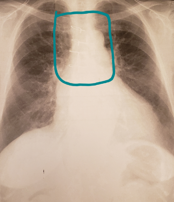 レントゲンで肺炎などはありませんか 母 84 が本日撮 Yahoo 知恵袋