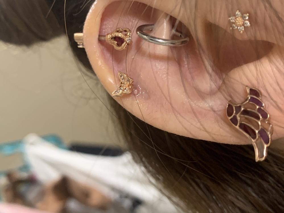 蝶のピアスの下に出来ている白いできものは 肉芽でしょうか 2日ほ Yahoo 知恵袋