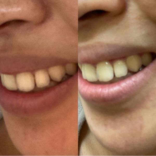 歯と歯の隙間目立ちますか 歯列矯正が終わってリテーナー Yahoo 知恵袋