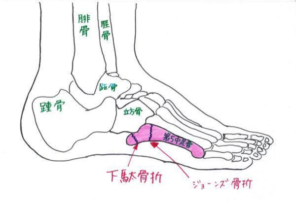 第五中足骨基部骨折について 家の階段で足を挫いて 小指側を内側に向 Yahoo 知恵袋