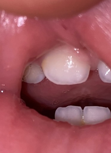 21日で1歳1ヶ月になる女の子です これは虫歯でしょうか 上 Yahoo 知恵袋
