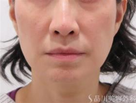 品川美容外科のハートチークってありますけど あれは効果あるん Yahoo 知恵袋